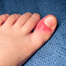 Image result for Toenail Removal