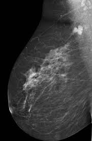 3d mammography creates more precise images to detect breast cancer shots health news npr. Axillary Lymph Nodes Mammogram Radiology Case Radiopaedia Org