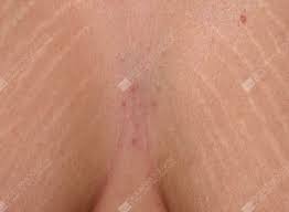 Stretch marks begin as flat red lines, and they appear as slightly depressed white streaks over time. Stretch Mark Removal Treatments Celluclear