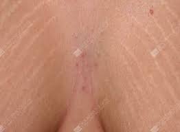 Over time they may diminish, but will not disappear completely. Stretch Mark Removal Treatments Celluclear