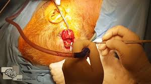 Normal Pressure Hydrocephalus Vp Shunt Sant Takilmasi Hidrosefali Youtube