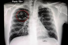 Image result for lung cancer xray