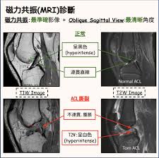 More Than Physio 飛躍物理治療綜合專科中心– 前十字韌帶受傷
