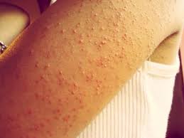 Cheap And Easy Way To Get Rid Of Bumps On Your Arms And Thighs Fashion Beauty Trusper Tip Pimples On Buttocks Pimples On Chin Keratosis Pilaris
