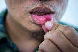 These send information about how our site is used to unexplained, persistent numbness or an odd feeling on the lip or tongue. Mouth Ulcers Can Be More Than A Pain They Can Hint At Something More Serious Here S What To Watch For Abc News