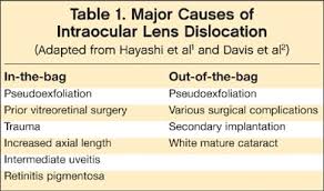 Image result for Lens Dislocation