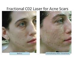 Pin On Remove Acne Scars