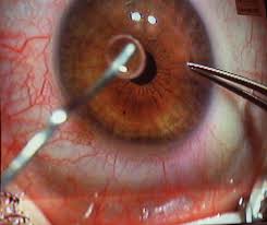 During the procedure, you lie on your back in a reclining chair. Why Lasik And Other Laser Eye Surgery Carries Risk Maybe Even Suicide