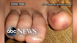 We did not find results for: What Is Covid Toe