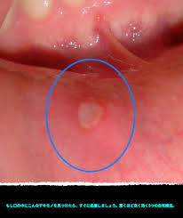 もし口の中にこんなデキモノを見つけたら すぐに処置しましょう 驚くほど良く効く5つの自宅療法 健康 美容 自然療法