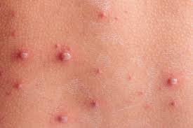 Rashes In Children The Pharmaceutical Journal