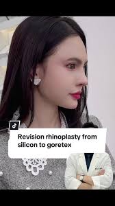 The client's old nose, which had silicone rhinoplasty, was too high an...