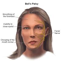 For some, however, the symptoms may last longer. Tmj Bell S Palsy Emergency Dentist Boca Raton