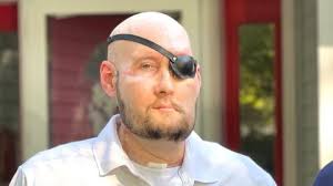 El primer trasplante mundial de ojo y cara da nuevas esperanzas a un hombre  de Arkansas