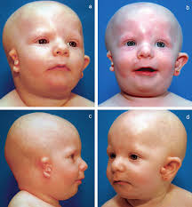 BOLETÍNdel ECEMC· Revista de Dismorfología y Epidemiología