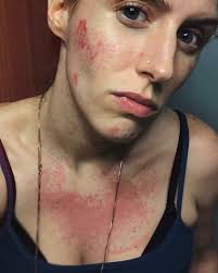 Woman Develops Rare Flesh Eating Bacteria That Ate At Her Face After Trip To Asia Flesh Eating Bacteria Severe Acne Face Breaking Out