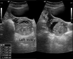 Image result for corpus luteum sonography)
