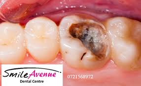 You can expect to have some mild to moderate pain or soreness in the area after a root canal treatment. Myths About Root Canal Treatment Smile Avenue