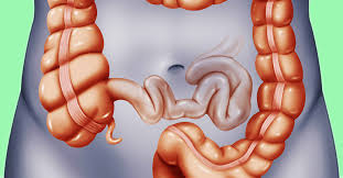 Ostematrix yang sesuai untuk masalah sembelit ibu hamil dan berpantang. Sembelit Selepas Bersalin Berapa Lama Dan Bagaimana Cara Mengatasi Sembelit Portal Ibu Bersalin