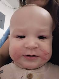 Looking for a natural treatment for hyperthyroidism , my daughter has just  been diagnosed