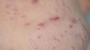 Hs Symptoms Pictures No Bs About Hs
