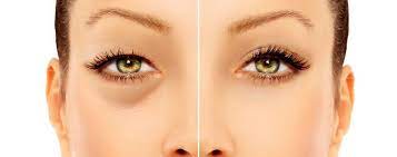Como Quitar Las Ojeras Oscuras Y Hundidas