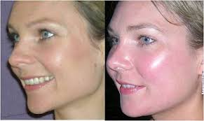 I had serious weight gain and 'moon face!' the picture on the right is the following summer after being off of prednisone and getting back to my normal, healthy weight. — brianna d. Drugstore Pas Cher Prednisone Forum Reductions Et La Livraison Gratuite Appliquee Alergia Y Asma