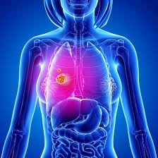 It can be ailments in the form of urinary disorders, constipation, flatulence, feeling of heaviness or abdominal pain, pain. 9 Signs And Symptoms Of Lung Cancer According To Doctors