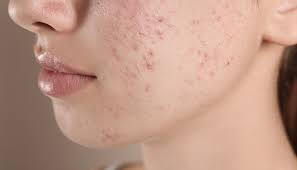 Image result for demodex rosacea