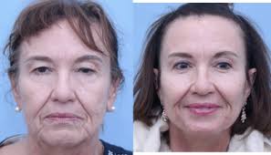 Garrett Griffin, MD, Board Certified Facial Plastic Surgeon