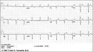 Ecg Learning Center An Introduction To Clinical Electrocardiography