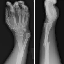 Image result for Wrist XRay