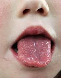 Image result for brown tongue symptoms