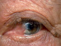 Image result for Conjunctival Foreign Body