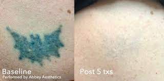 Owner and laser removal expert mary over at clean slate laser removal, is a master in her field. Laser Tattoo Removal Enlighten Latest And Most Effective Technology Fastest Results Hartford Ct