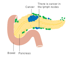 If the cancer spreads to other tissues and organs, it may decrease a patient's likelihood of survival. Pancreatic Cancer Wikipedia