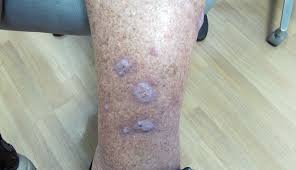 Image result for Pigment stains on the shin