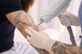 This means that only approved medical personnel can perform the procedure, and consequently, laser … Laser Tattoo Removal Course Become A Laser Tattoo Removal Technician Tattoo Removal Courses Nz Tattoo Removal Certificate Nz Laser Training Institute