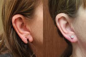 What does skin cancer look like? Earlobe Repair Upland Ca Skin Physicians Surgeons