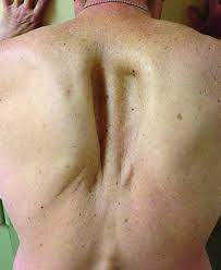 People with this disease collect fat on certain areas of the body, such as the torso, face, and neck. Parascapular Muscle Atrophy As A Delayed Effect Of Radiation Treatment Practical Neurology