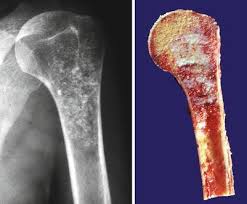 Image result for Chondrosarcoma