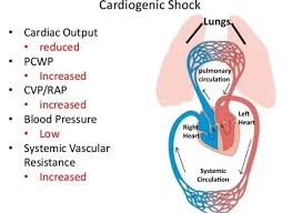 Cardiogenic Shock | Heartplace | Cardiovascular Disease Specialists &  Cardiac Electrophysiologists located in Allen, Fort Worth, Arlington,  Dallas, Plano, Corsicana, Garland, Glen Rose, Bedford, Burleson, Mansfield,  Richardson, North Richland Hills ...