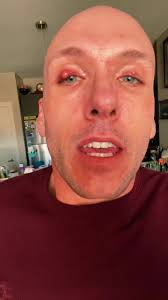 We only live once! #eyes #fyp #pimples #beauty #doctor