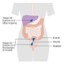Endometrial cancer stages range from stage i (1) through iv (4). Endometrial Cancer Wikipedia