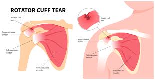 Image result for Rotator Cuff Rupture