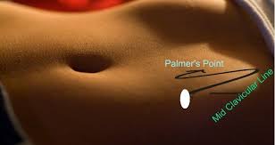 Palmer's point can be used in patients with suspected periumbilical adhesions, a history of an umbilical hernia, or multiple failed attempts of insufflations at the umbilicus. Principle Of Laparoscopic Port Position