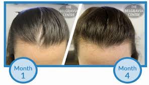 Hair loss can be one of your major concerns as it may drastically affect your overall look and personality. there are various reasons which can cause hair loss and so as can minoxidil regrow hair? this must be one of the most obvious questions growing in your mind; Why Am I Losing More Hair After Just Starting Minoxidil