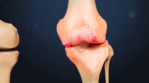 Tratament acid hialuronic pentru marire buze, pentru volum pometi, tratament acid hialuronic pentru corectie cearcane, conturare faciala. Tratament Injectabil Pt Gonartroza Inapoi De Genunchi Doare Atunci Cand Exercitarea