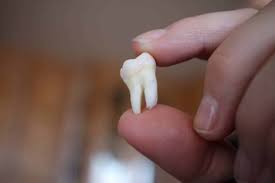 What Are Wisdom Teeth? - Pristine Dentalworks
