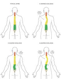 Scoliosis And Yoga The Do S And Don Ts Scoliosis Exercises Scoliosis Yoga For Scoliosis